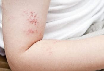 Shingles vaccine will be free to 60-year-olds from next year