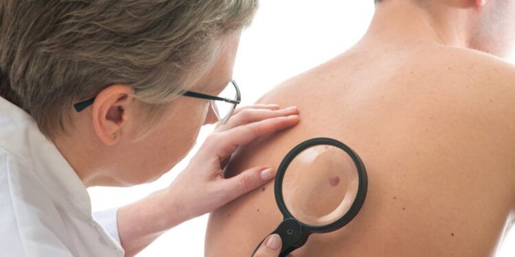 Fewer lung and colon cancer cases, skin and prostate cancers up