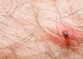 Spring weather leads to a surge in tick bites nationwide