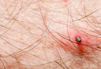 Spring weather leads to a surge in tick bites nationwide