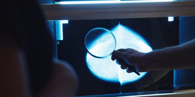 Test which spares breast cancer sufferers chemo not used enough
