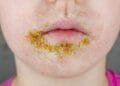 Highly contagious impetigo infection on the rise among children