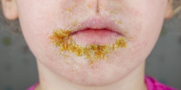 Highly contagious impetigo infection on the rise among children