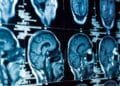 Amsterdam researchers find remedy for fatal child brain disease