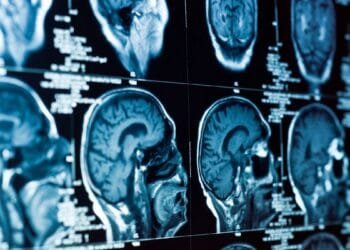 Amsterdam researchers find remedy for fatal child brain disease