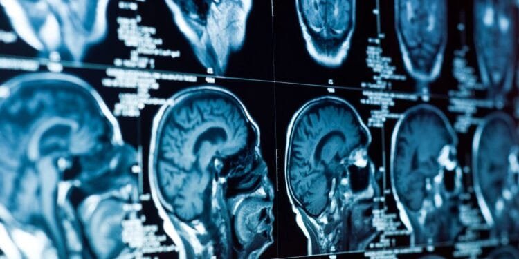 Amsterdam researchers find remedy for fatal child brain disease